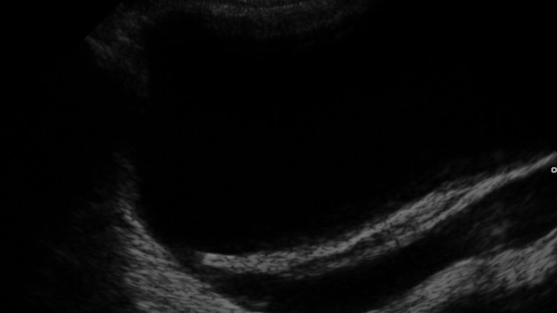Ultrasound